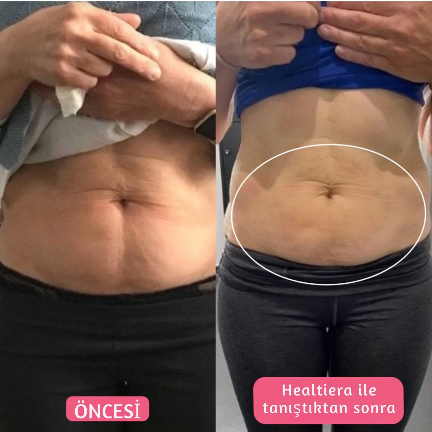 Healthierly Tricore Teknolojisiyle Güçlendirilmiş Yağ Yakma Kemeri!