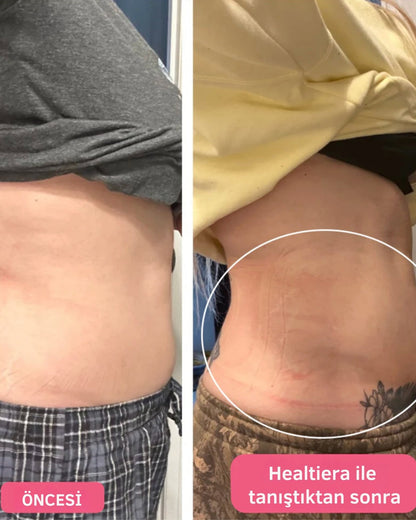 Healthierly Tricore Teknolojisiyle Güçlendirilmiş Yağ Yakma Kemeri!