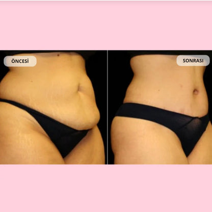 Healthierly Tricore Teknolojisiyle Güçlendirilmiş Yağ Yakma Kemeri!